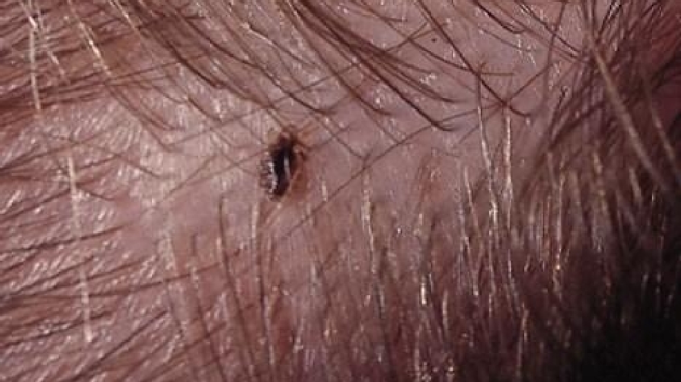 Arkansas One Of 25 States With Super Strain Of Head Lice Katv