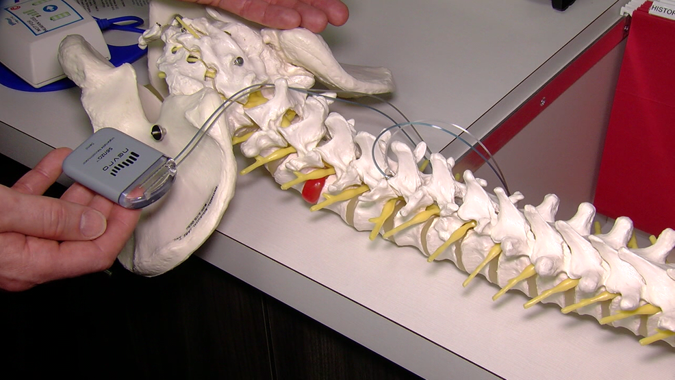 New Back Therapy Offers Relief For Patients | WKRC