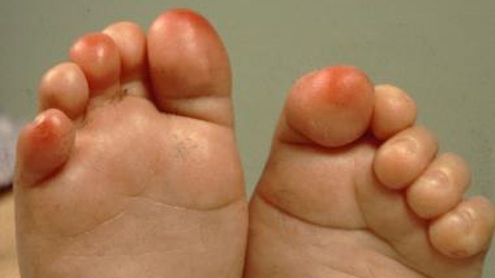 Dermatologists Link Swollen Discolored Toes To COVID 19 Exposure WCIV