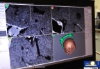 Better Success with Brain Surgery:  Advanced imaging technology improves precision